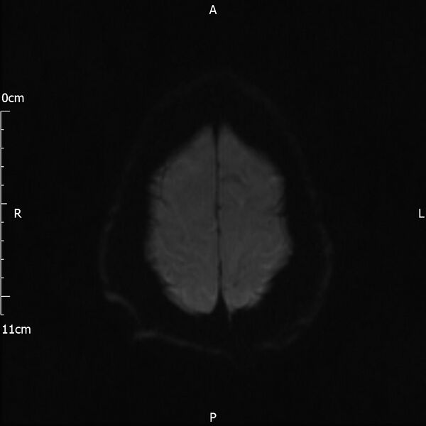 File:Cerebral amyloid angiopathy related inflammation (Radiopaedia 72772-83415 Axial DWI 44).jpg