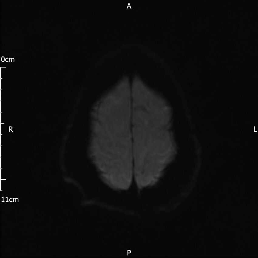 Cerebral amyloid angiopathy related inflammation (Radiopaedia 72772-83415 Axial DWI 44).jpg