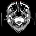 Cerebral and orbital tuberculomas (Radiopaedia 13308-13310 Axial non-contrast 1).jpg