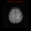 Cerebral and orbital tuberculomas (Radiopaedia 13308-13311 Axial FLAIR 16).jpg