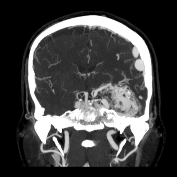 File:Cerebral arteriovenous malformation (Radiopaedia 43729-47189 C 22).jpg