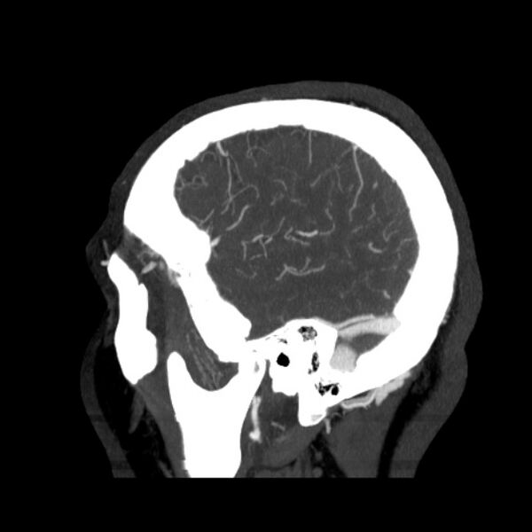 File:Cerebral arteriovenous malformation (Radiopaedia 43729-47189 D 7).jpg