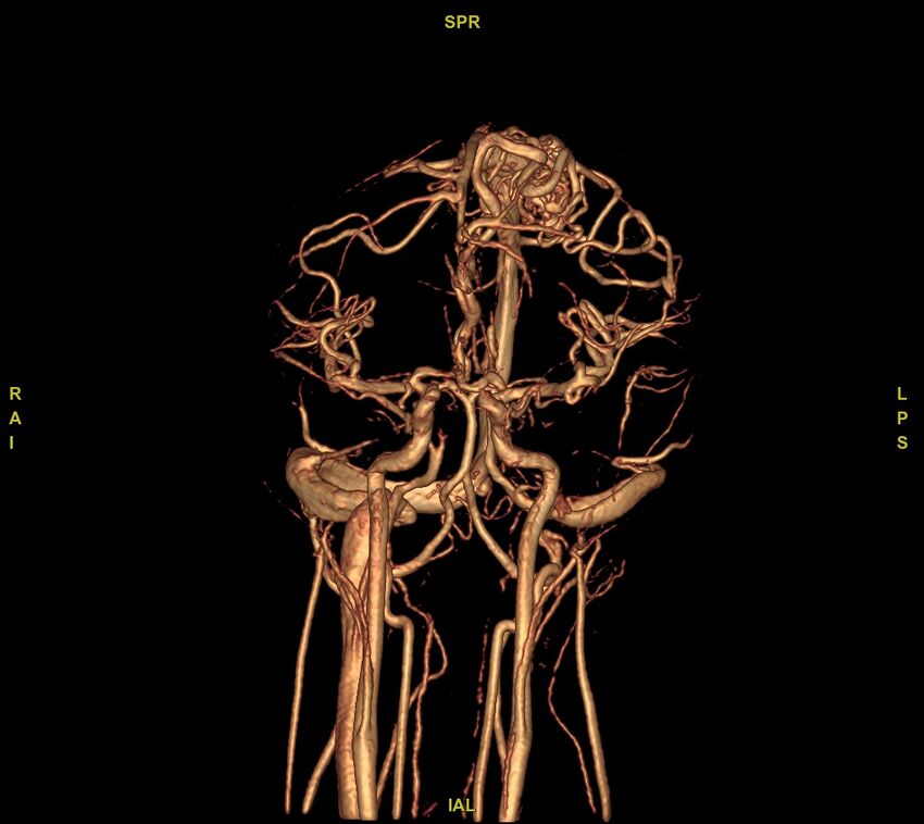 Cerebral arteriovenous malformation (Radiopaedia 61964-70029 VRT 41).jpg