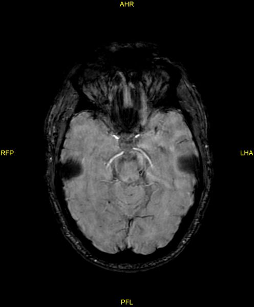 File:Cerebral autosomal dominant arteriopathy with subcortical infarcts and leukoencephalopathy (CADASIL) (Radiopaedia 86108-102054 Axial SWI 43).jpg