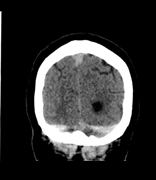 File:Cerebral dural venous sinus thrombosis (Radiopaedia 86514-102575 Coronal non-contrast 47).jpg