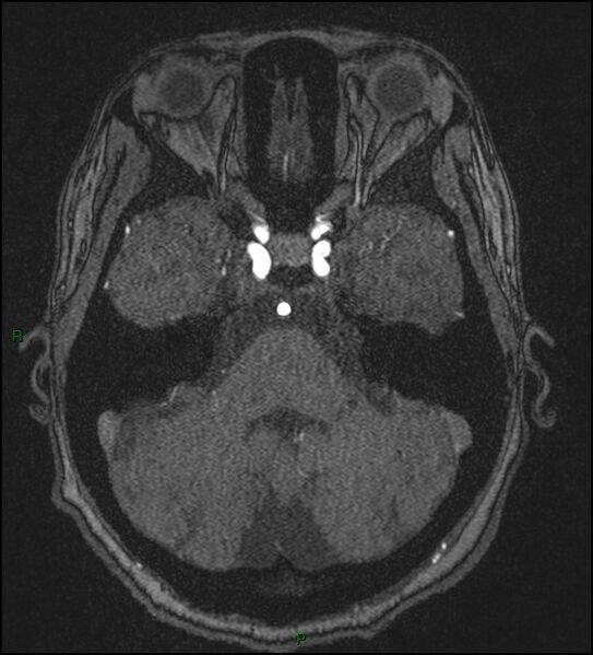 File:Cerebral fat embolism (Radiopaedia 35022-36525 Axial TOF 51).jpg