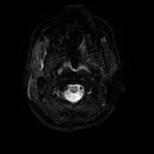 File:Cerebral fat embolism (Radiopaedia 37510-39363 Axial DWI 26).jpg