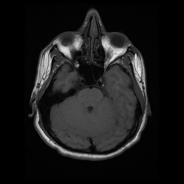 File:Cerebral fat embolism (Radiopaedia 37510-39363 Axial T1 9).jpg