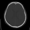 Cerebral hemorrhagic contusions (Radiopaedia 23145-23188 Axial bone window 34).jpg