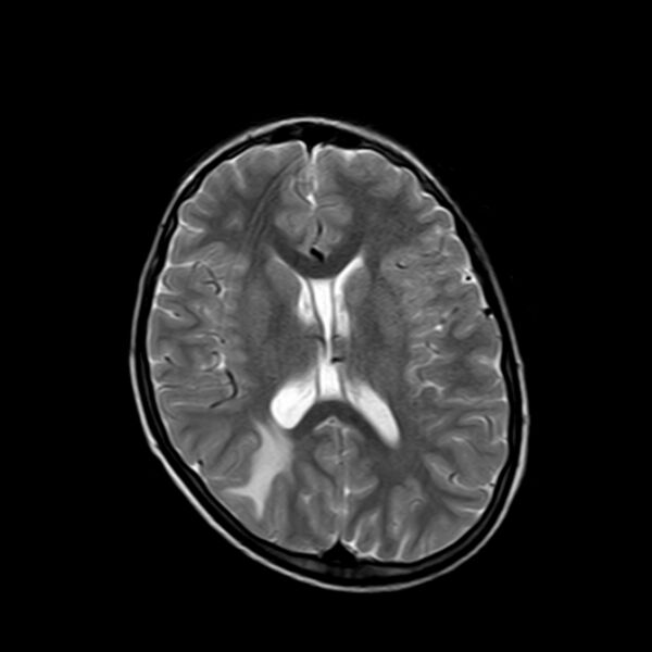 File:Cerebral tuberculoma (Radiopaedia 41152-43932 Axial T2 13).jpg