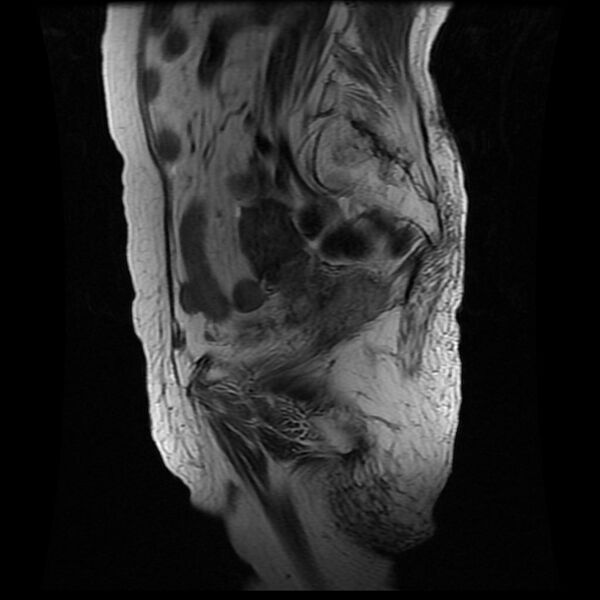 File:Cervical carcinoma (Radiopaedia 78847-91705 Sagittal T2 5).jpg