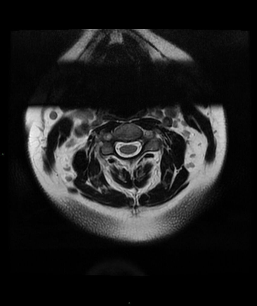 Cervical disc prolapse (Radiopaedia 80258-93598 Axial T2 1).jpg