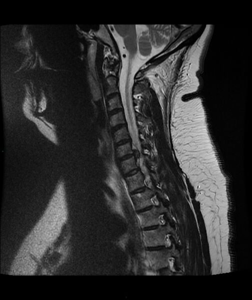 File:Cervical disc prolapse (Radiopaedia 80258-93598 Sagittal T2 10).jpg