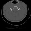 Cervical flexion teardrop fracture with cord hemorrhage (Radiopaedia 32497-33454 Axial bone window 39).jpg