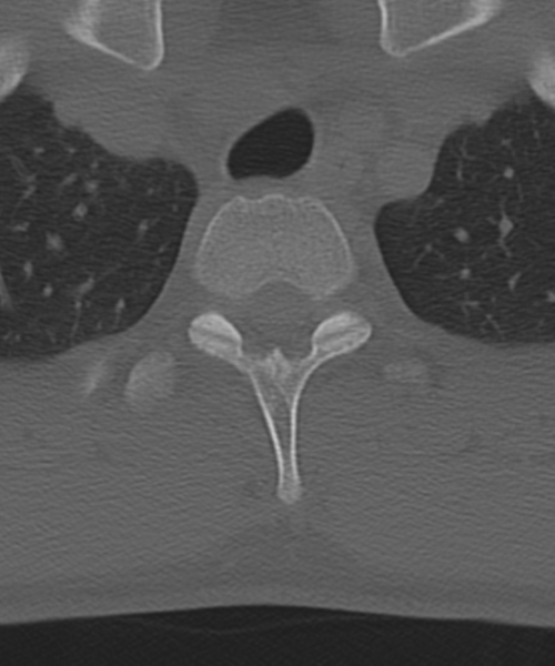 File:Cervical intercalary bone (Radiopaedia 35211-36748 Axial bone window 68).png
