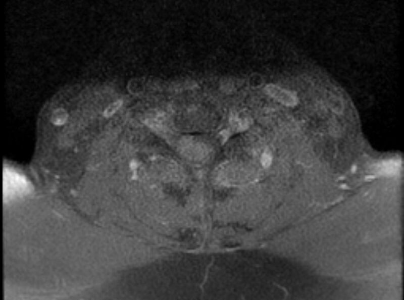 File:Cervical schwannoma (Radiopaedia 72399-82934 Axial T1 C+ fat sat 14).jpg
