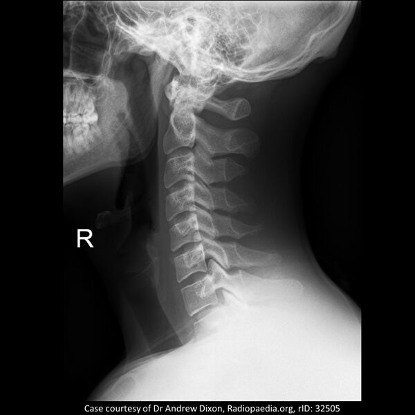 File:Cervical spine anatomy (Radiopaedia 58729-65951 B 1).jpg