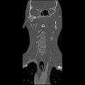 Cervical spine fractures with vertebral artery dissection (Radiopaedia 32135-33078 Coronal bone window 5).jpg