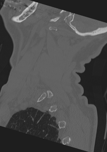 File:Cervical spine fractures with vertebral artery dissection (Radiopaedia 53296-59268 Sagittal bone window 7).png