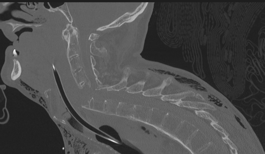 Chalk stick fracture (Radiopaedia 57948-64928 Sagittal bone window 33).png