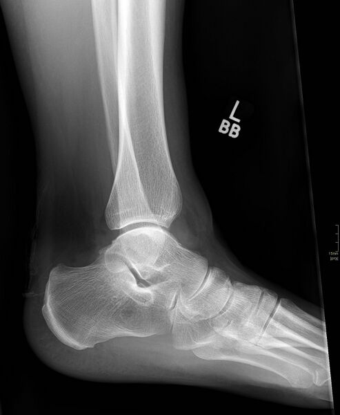 File:Chaput tubercle fracture (Radiopaedia 80319-93680 Lateral 1).jpg