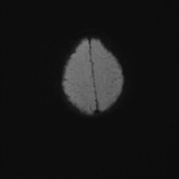 File:Chiari III malformation with occipital encephalocele (Radiopaedia 79446-92559 Axial DWI 37).jpg