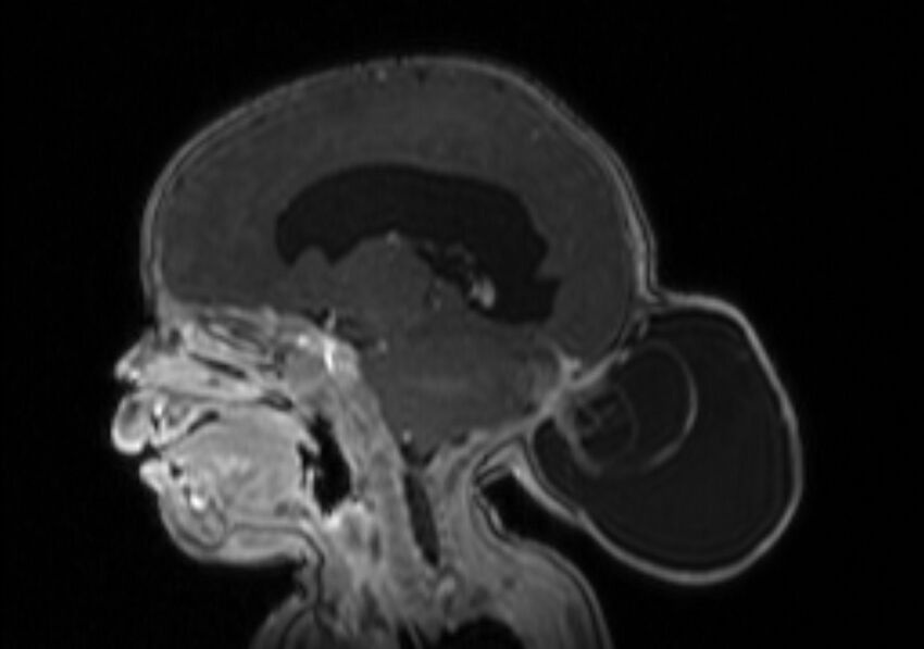 Chiari III malformation with occipital encephalocele (Radiopaedia 79446-92559 Sagittal T1 C+ mpr 32).jpg