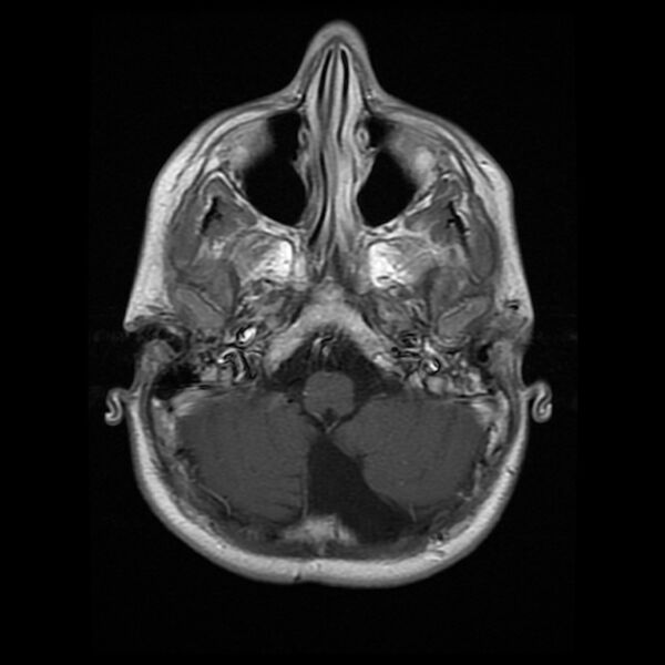 File:Chiasmatic-hypothalamic juvenile pilocytic astrocytoma (Radiopaedia 78533-91236 Axial T1 C+ 7).jpg