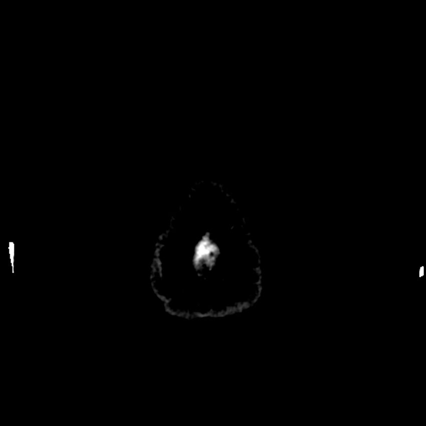 Chiasmatic-hypothalamic juvenile pilocytic astrocytoma (Radiopaedia 78533-91237 Axial non-contrast 57).jpg