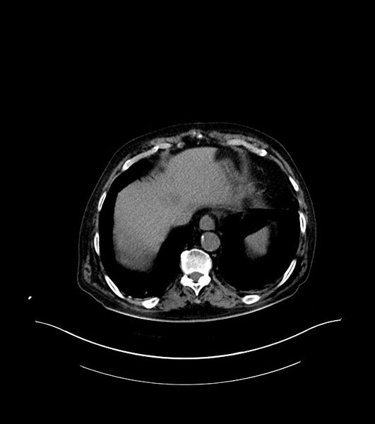 File:Cholangiocarcinoma with cerebral metastases (Radiopaedia 83519-98629 Axial non-contrast 10).jpg