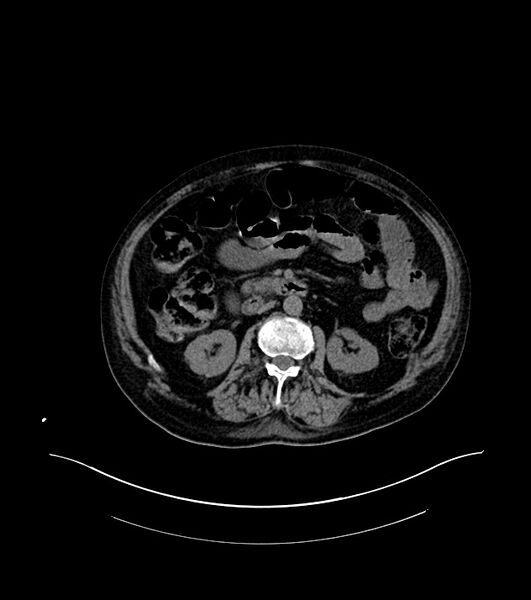 File:Cholangiocarcinoma with cerebral metastases (Radiopaedia 83519-98629 Axial non-contrast 49).jpg