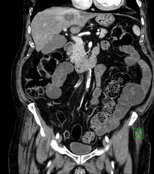 File:Cholangiocarcinoma with cerebral metastases (Radiopaedia 83519-98629 E 41).jpg
