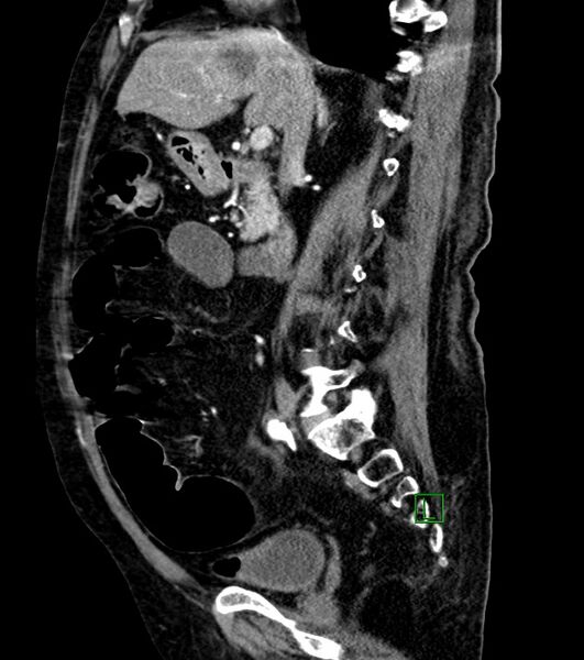 File:Cholangiocarcinoma with cerebral metastases (Radiopaedia 83519-98629 F 71).jpg