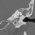 Cholesteatoma (Radiopaedia 9408-10093 Coronal bone window 3).jpg