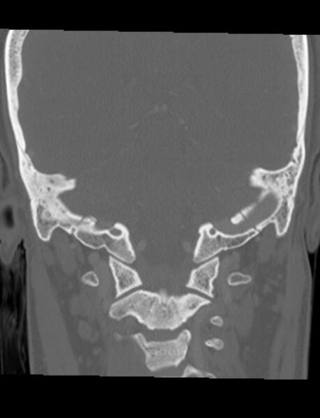 File:Cholesteatoma (pars flaccida) (Radiopaedia 28782-29083 Coronal bone window 4).jpg