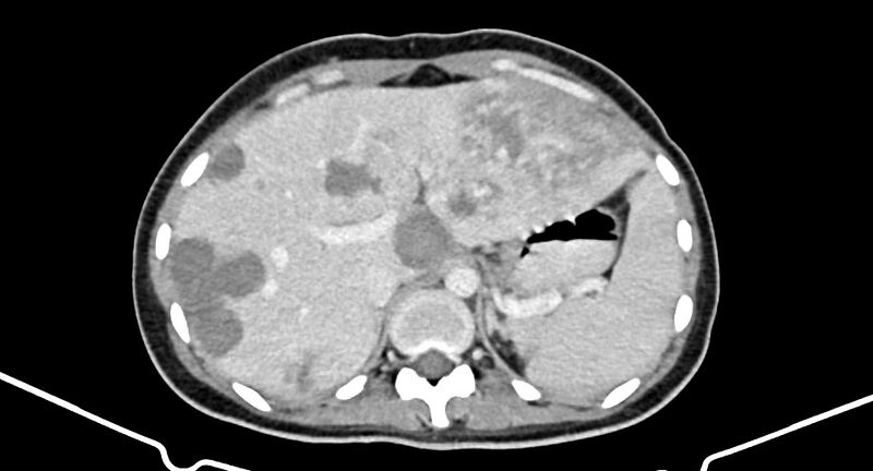 File:Choriocarcinoma liver metastases (Radiopaedia 74768-85766 A 60).jpg