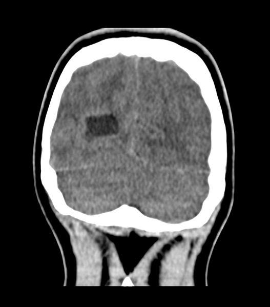 File:Choroid plexus carcinoma (Radiopaedia 91013-108552 Coronal 24).jpg