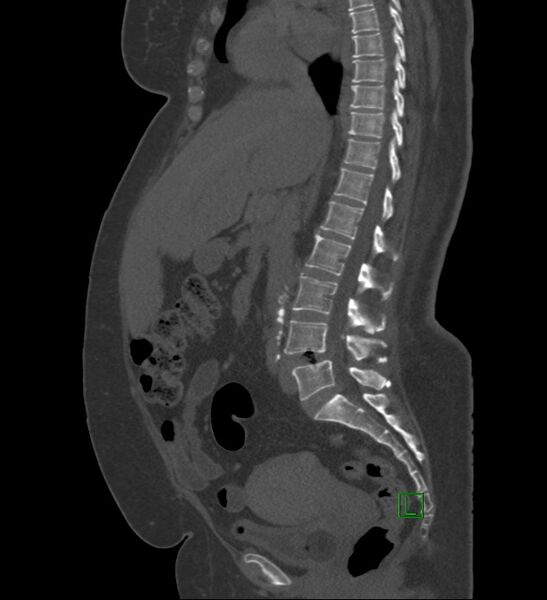 File:Chromophobe renal cell carcinoma (Radiopaedia 84239-99519 Sagittal bone window 58).jpg