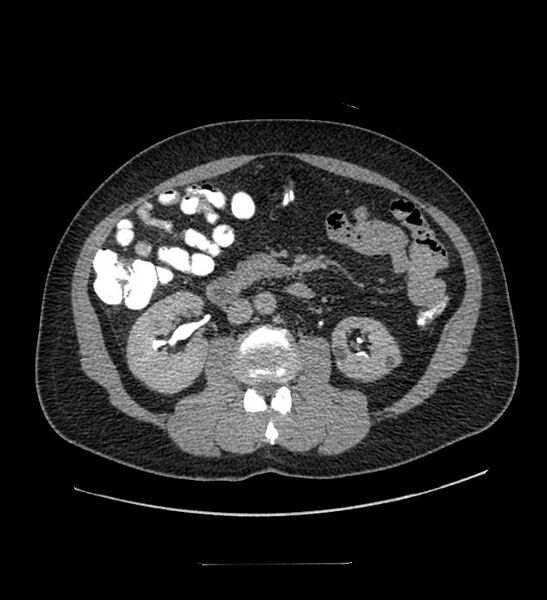 File:Chromophobe renal cell carcinoma (Radiopaedia 84337-99644 Axial C+ delayed 68).jpg