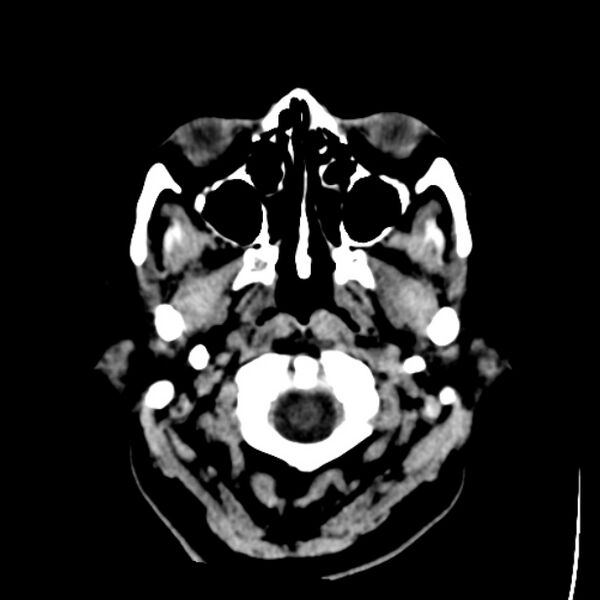 File:Chronic bilateral occipital lobe infarcts (Radiopaedia 31276-31996 Axial non-contrast 2).jpg