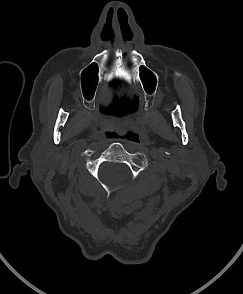 File:Chronic bilateral subdural hygroma (Radiopaedia 85801-101623 Axial bone window 122).jpg