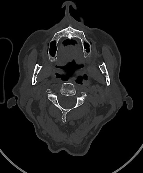 File:Chronic bilateral subdural hygroma (Radiopaedia 85801-101623 Axial bone window 125).jpg