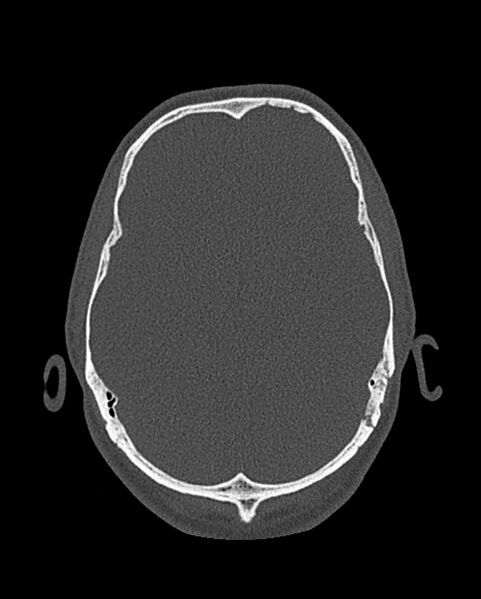 File:Chronic maxillary sinusitis caused by a foreign body (Radiopaedia 58521-65676 Axial bone window 321).jpg