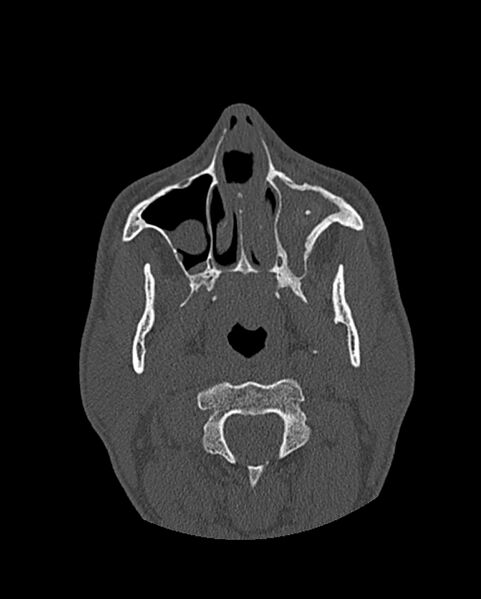 File:Chronic maxillary sinusitis caused by a foreign body (Radiopaedia 58521-65676 Axial bone window 94).jpg