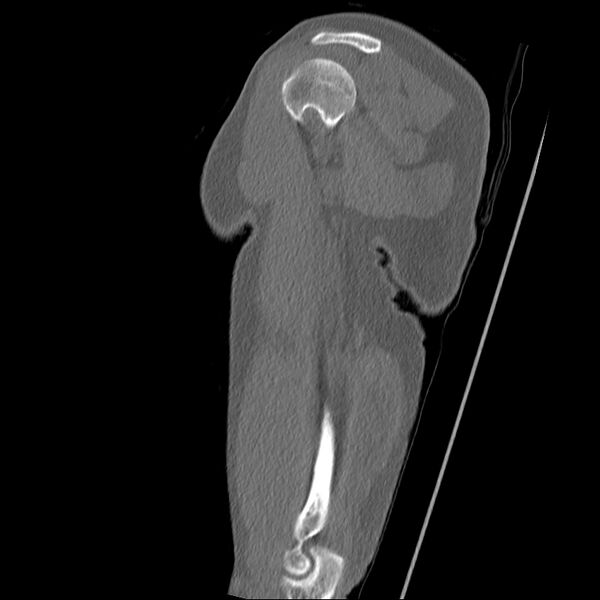 File:Chronic osteomyelitis (Radiopaedia 67597-76998 Sagittal bone window 9).jpg