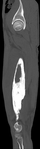 File:Chronic osteomyelitis (with sequestrum) (Radiopaedia 74813-85822 C 83).jpg