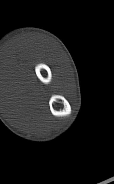 File:Chronic osteomyelitis of the distal humerus (Radiopaedia 78351-90971 Axial bone window 112).jpg
