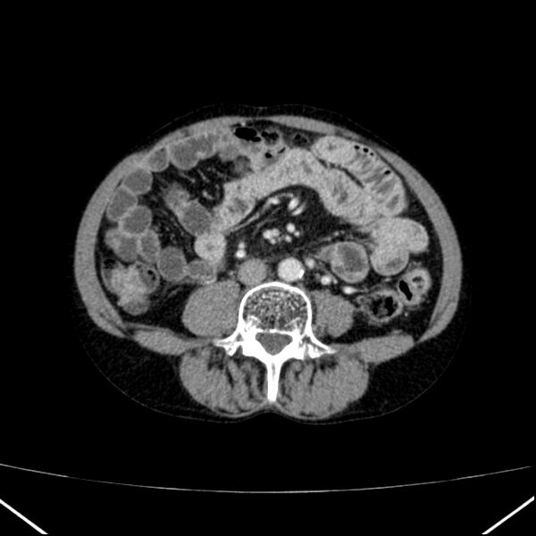 File:Chronic pancreatitis (Radiopaedia 23132-23172 B 38).jpg