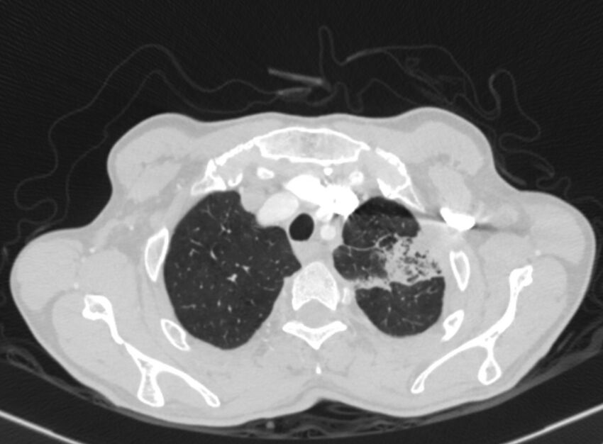Chronic pulmonary embolism with bubbly consolidation (Radiopaedia 91248-108850 Axial lung window 21).jpg