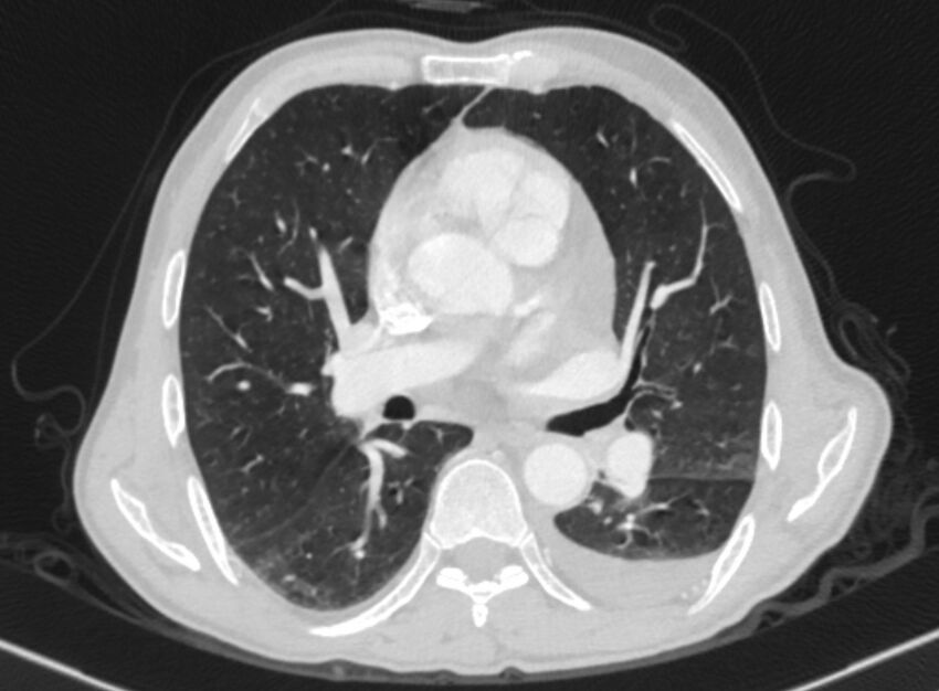 Chronic pulmonary embolism with bubbly consolidation (Radiopaedia 91248-108850 Axial lung window 82).jpg